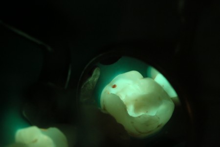 Grüngelbe völlig gesunde Dentinanteile im aufgebohrtem Zahn mit einer ROTEN Stelle, die Kariesaktivität anzeigt und entfernt werden muss