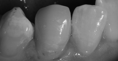Eingeklebtes Veneer 