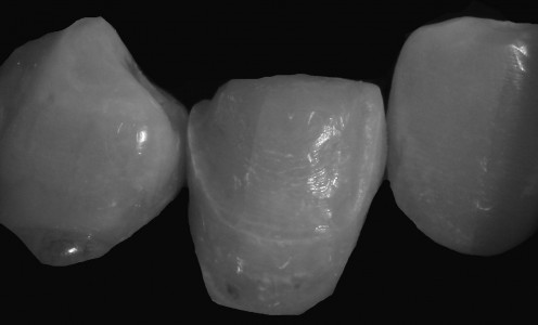 Zahn im beschliffenen Zustand für die Aufnahme eines Veneers (Foto im Hintergrund reduziert zur Hervorhebung des Zahnes)