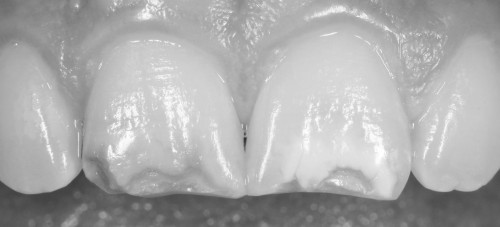 hypo2